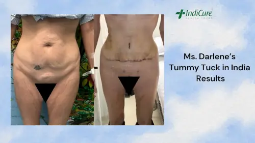 Ms. Darlene's Tummy Tuck in India Results Ms. Darlene's Tummy Tuck in India Results